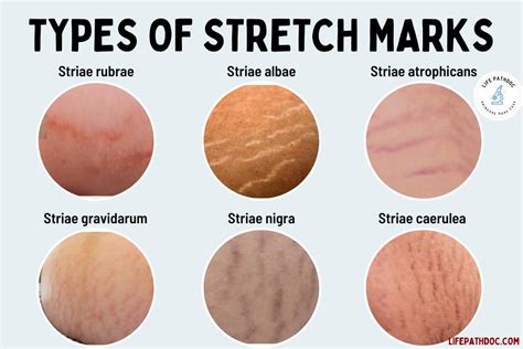 Why Do I Have Stretch Marks on My Biceps? And Why Do They Glow in the Dark Sometimes?